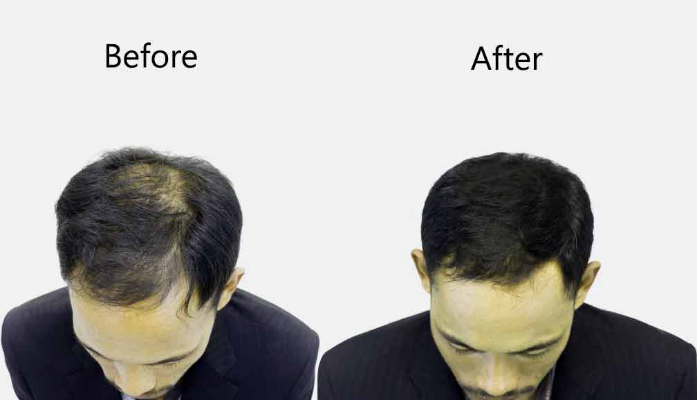 What Makes You A Good Candidate For Hair Transplant Surgery